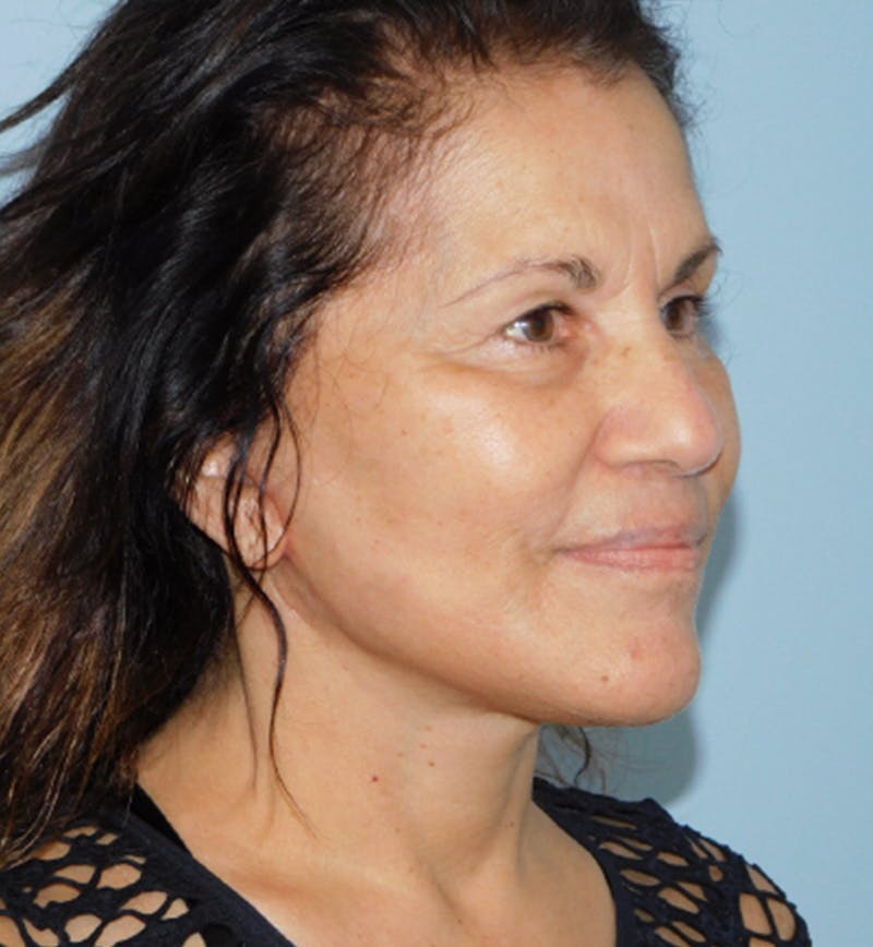 Mini-Facelift Before & After Gallery - Patient 133066296 - Image 4
