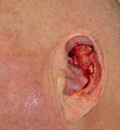 Reconstructive Surgery Before & After Gallery - Patient 133066293 - Image 1
