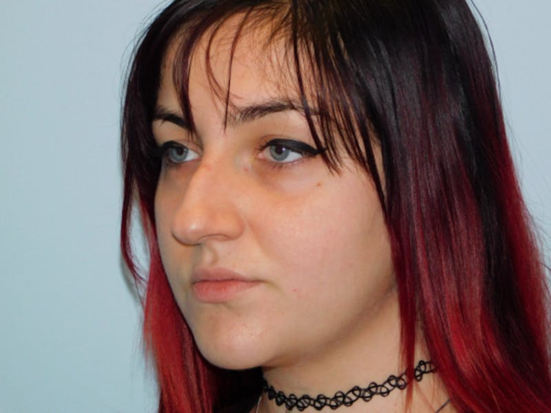 Rhinoplasty Before & After Gallery - Patient 133066302 - Image 5