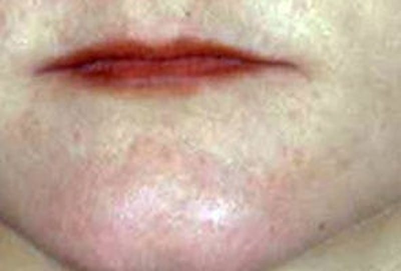 Lip Lift & Augmentation Before & After Gallery - Patient 133066294 - Image 1