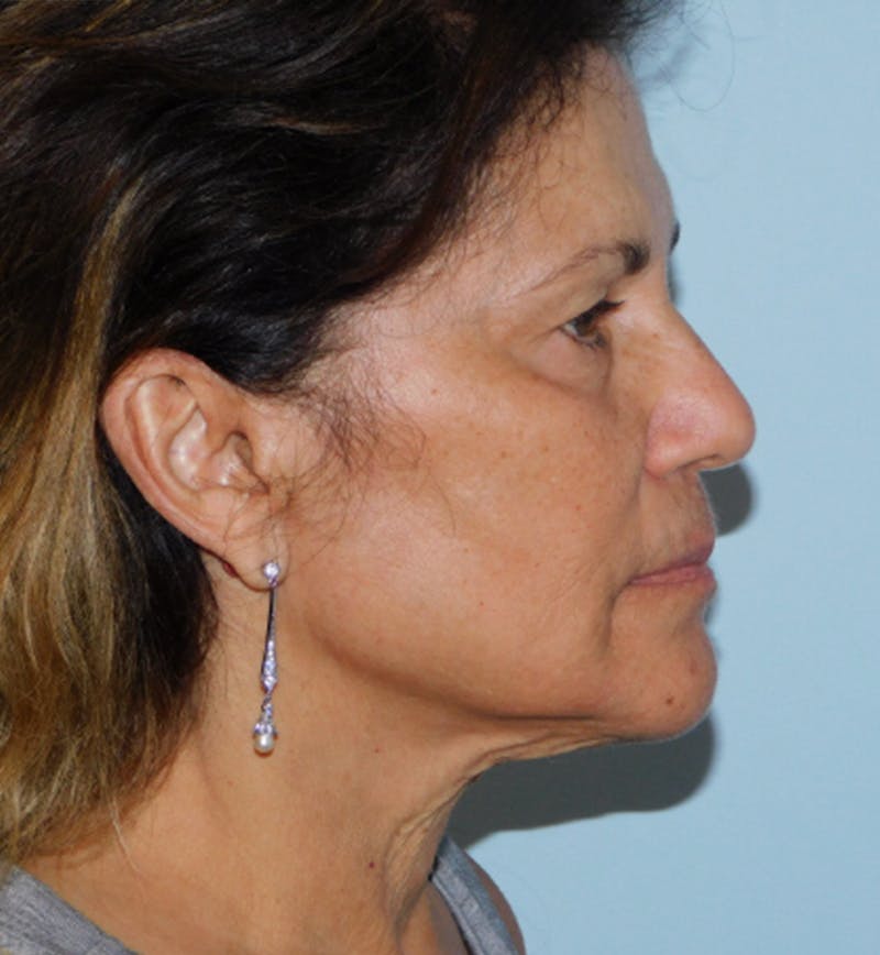 Mini-Facelift Before & After Gallery - Patient 133066296 - Image 5