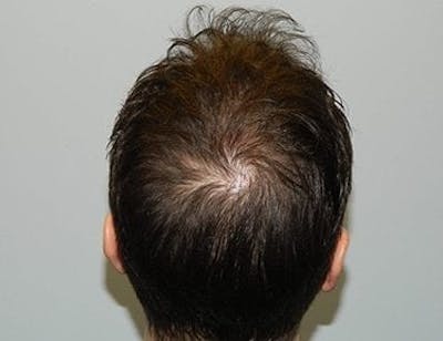 Hair Transplant (Smartgraft) Before & After Gallery - Patient 133066295 - Image 1