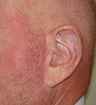 Reconstructive Surgery Before & After Gallery - Patient 133066293 - Image 2