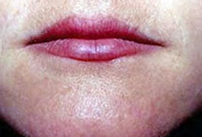 Lip Lift & Augmentation Before & After Gallery - Patient 133066294 - Image 2