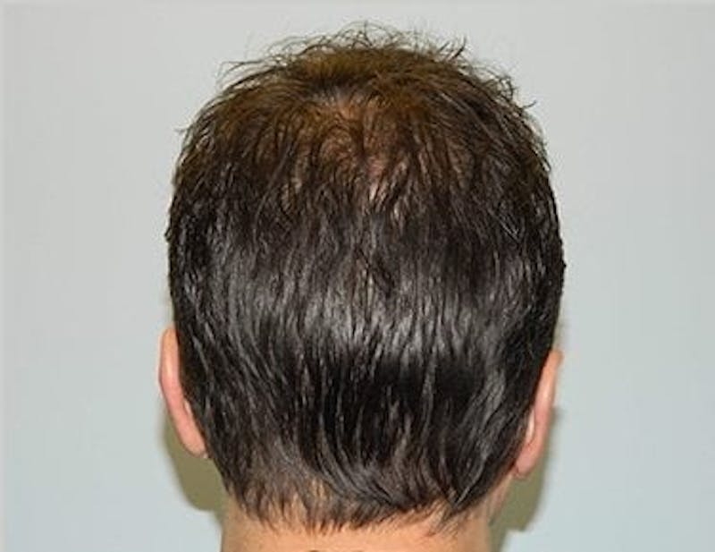 Hair Transplant (Smartgraft) Before & After Gallery - Patient 133066295 - Image 2