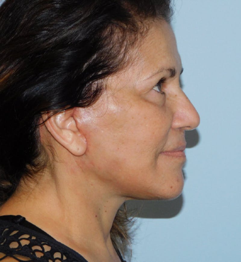 Mini-Facelift Before & After Gallery - Patient 133066296 - Image 6