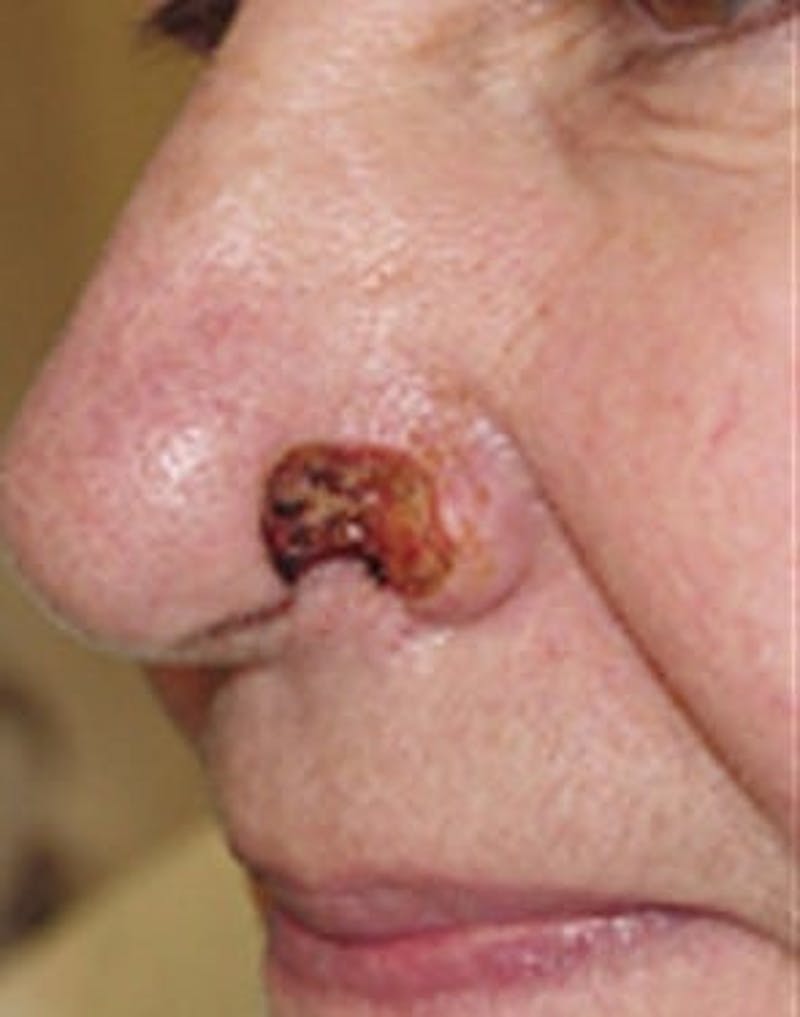Reconstructive Surgery Before & After Gallery - Patient 133066297 - Image 1
