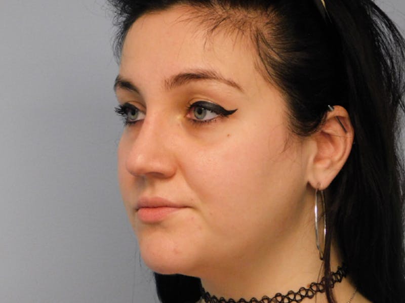 Rhinoplasty Before & After Gallery - Patient 133066302 - Image 6