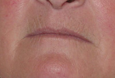 Lip Lift & Augmentation Before & After Gallery - Patient 133066299 - Image 1