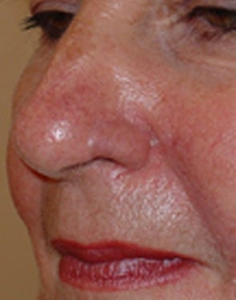 Reconstructive Surgery Before & After Gallery - Patient 133066297 - Image 2