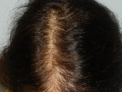 Hair Transplant (Smartgraft) Before & After Gallery - Patient 133066300 - Image 1
