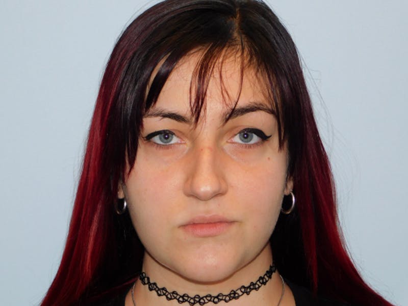Rhinoplasty Before & After Gallery - Patient 133066302 - Image 7