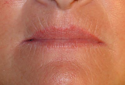 Lip Lift & Augmentation Before & After Gallery - Patient 133066299 - Image 2
