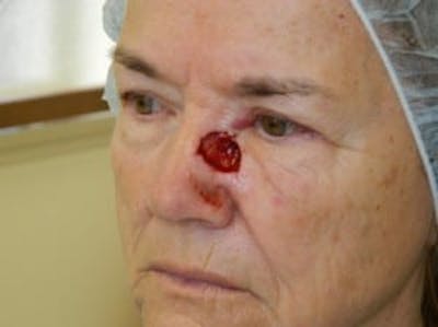 Reconstructive Surgery Before & After Gallery - Patient 133066301 - Image 1