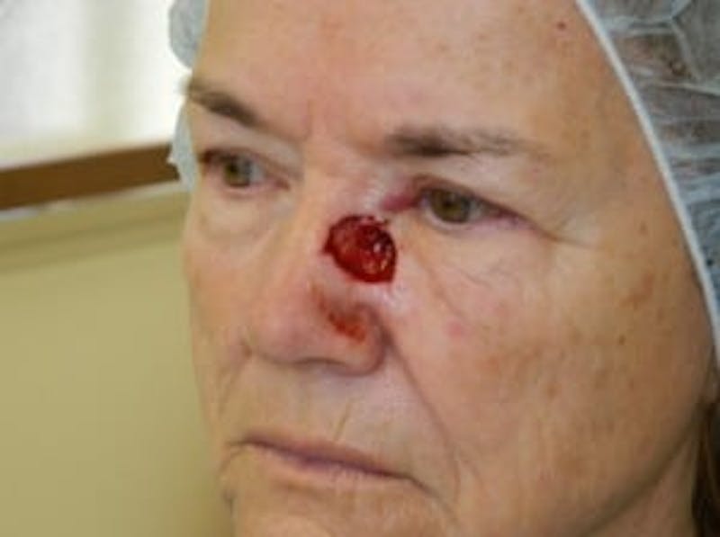 Reconstructive Surgery Before & After Gallery - Patient 133066301 - Image 1