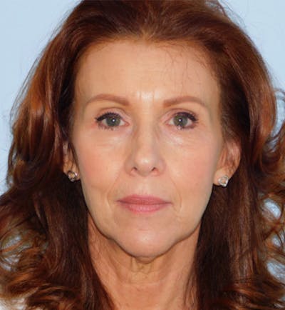Mini-Facelift Before & After Gallery - Patient 133066305 - Image 1