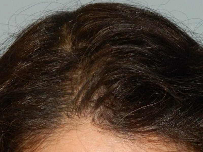 Hair Transplant (Smartgraft) Before & After Gallery - Patient 133066300 - Image 2