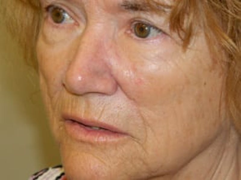 Reconstructive Surgery Before & After Gallery - Patient 133066301 - Image 2
