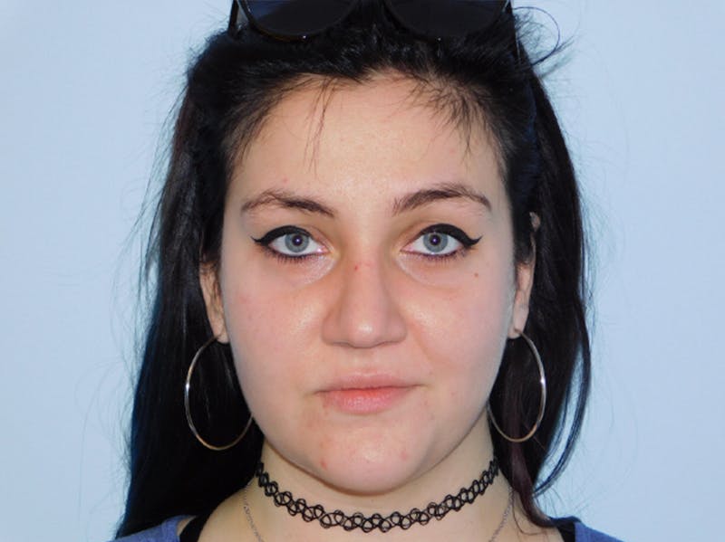 Rhinoplasty Before & After Gallery - Patient 133066302 - Image 8