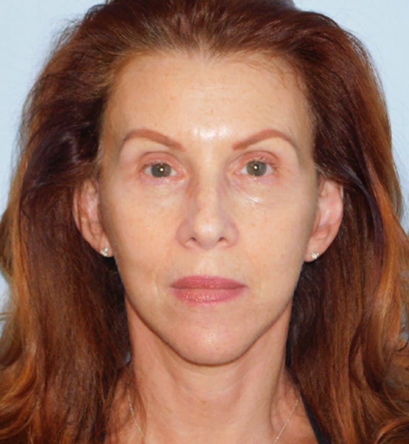 Mini-Facelift Before & After Gallery - Patient 133066305 - Image 2