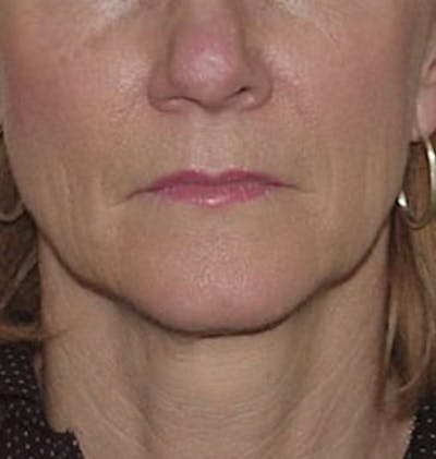 Lip Lift & Augmentation Before & After Gallery - Patient 133066303 - Image 1
