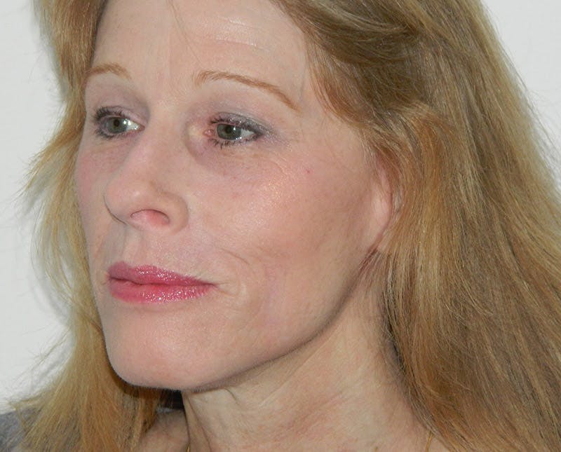 Brow Lift Before & After Gallery - Patient 133066307 - Image 2