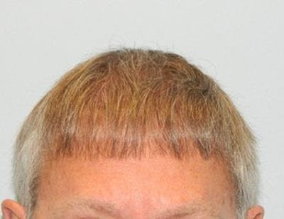 Hair Transplant (Smartgraft) Before & After Gallery - Patient 133066304 - Image 1