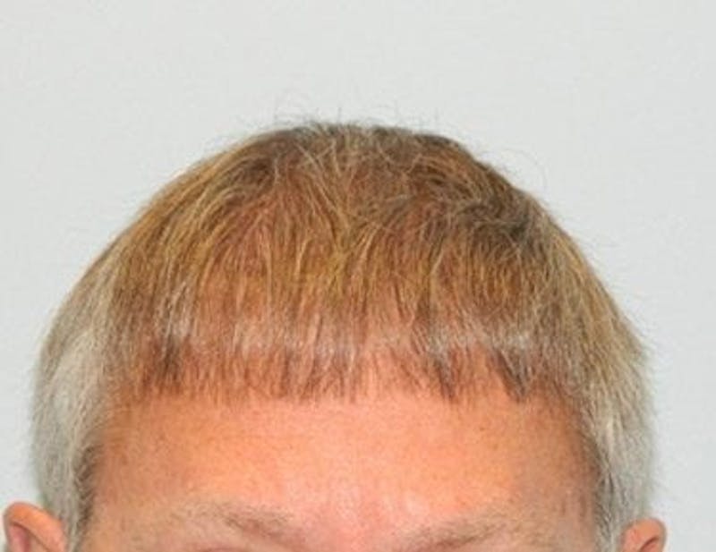 Hair Transplant (Smartgraft) Before & After Gallery - Patient 133066304 - Image 1