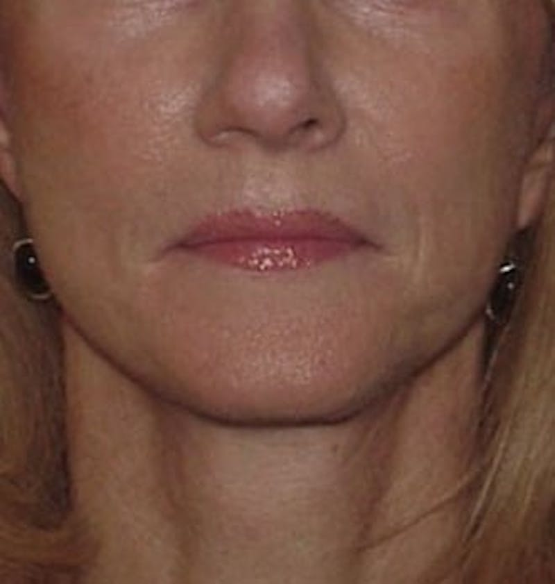 Lip Lift & Augmentation Before & After Gallery - Patient 133066303 - Image 2