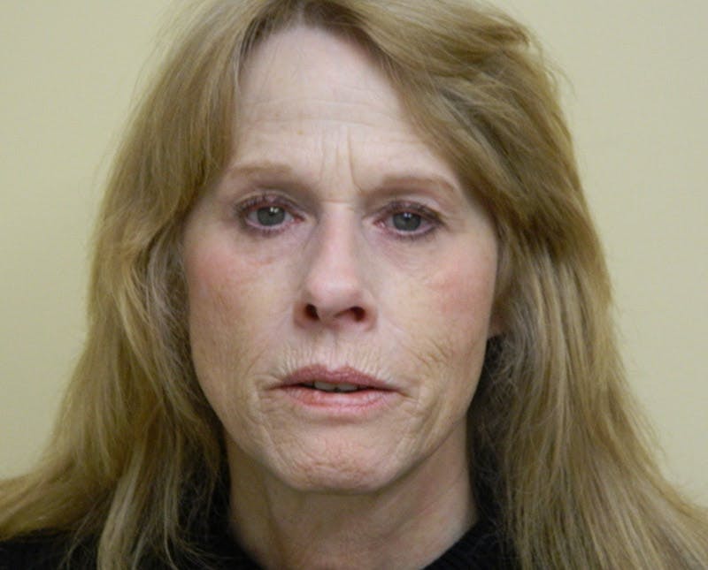 Brow Lift Before & After Gallery - Patient 133066307 - Image 3