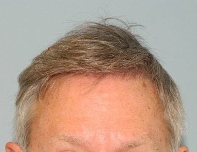 Hair Transplant (Smartgraft) Before & After Gallery - Patient 133066304 - Image 2