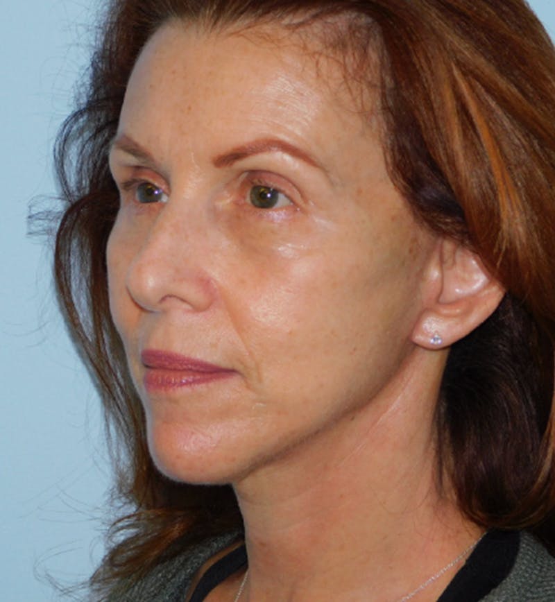 Mini-Facelift Before & After Gallery - Patient 133066305 - Image 4