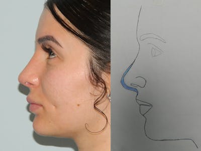 Rhinoplasty Before & After Gallery - Patient 133066313 - Image 2