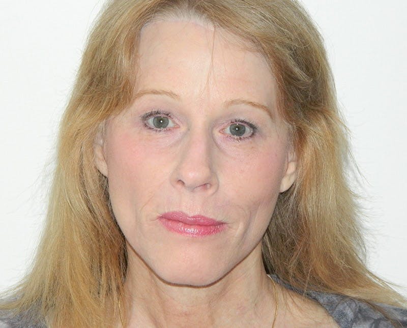 Brow Lift Before & After Gallery - Patient 133066307 - Image 4