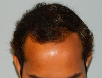 Hair Transplant (Smartgraft) Before & After Gallery - Patient 133066306 - Image 1