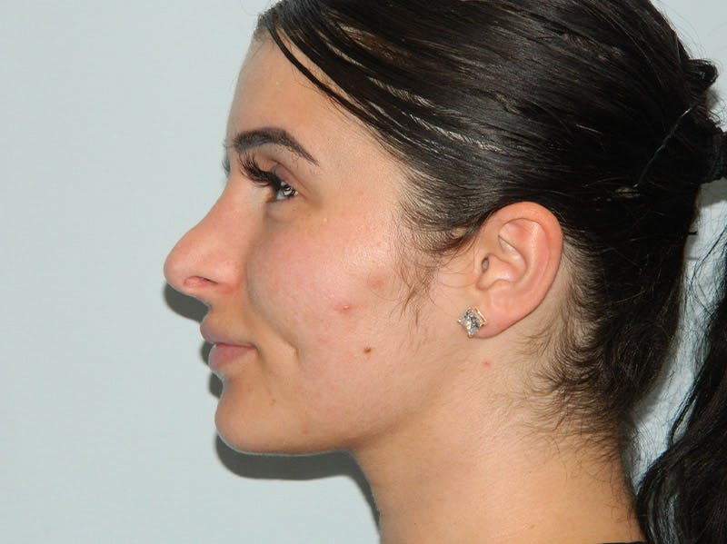 Before and After Rhinoplasty in Main Line