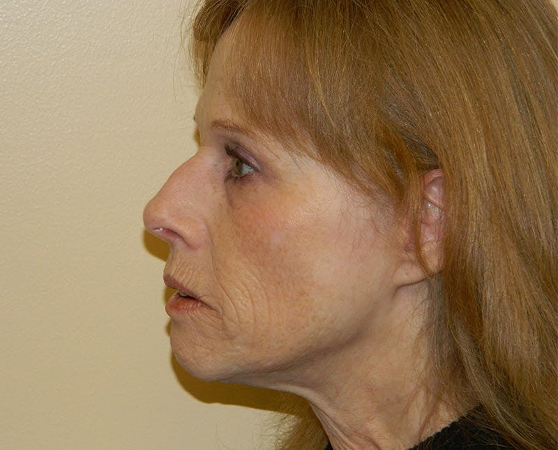 Brow Lift Before & After Gallery - Patient 133066307 - Image 5