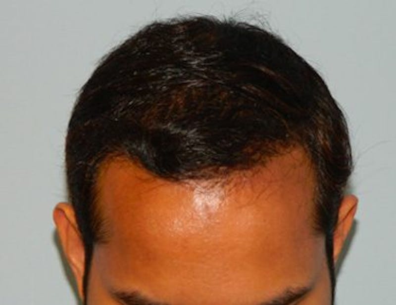 Hair Transplant (Smartgraft) Before & After Gallery - Patient 133066306 - Image 2