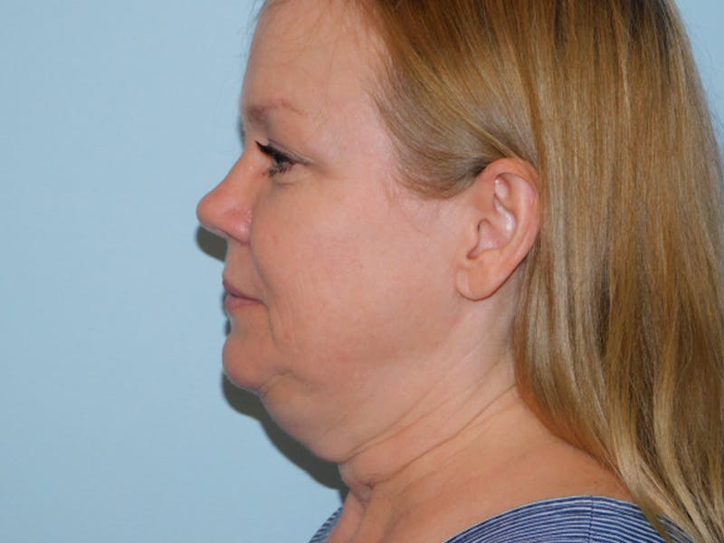 Mini-Facelift Before & After Gallery - Patient 133066311 - Image 1