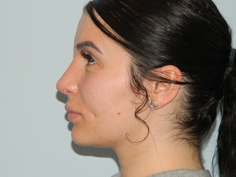 Before and After Rhinoplasty in Main Line