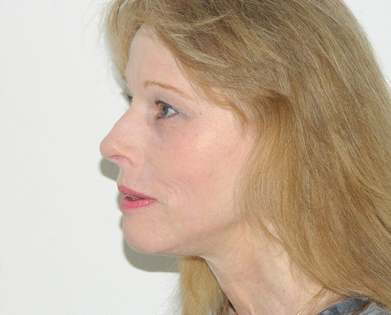 Brow Lift Before & After Gallery - Patient 133066307 - Image 6