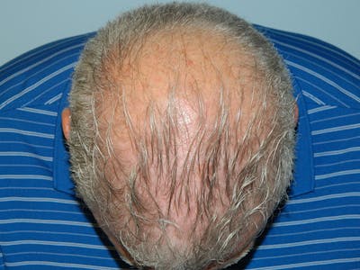 Hair Transplant (Smartgraft) Before & After Gallery - Patient 133066312 - Image 1