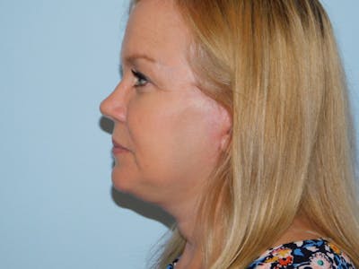 Mini-Facelift Before & After Gallery - Patient 133066311 - Image 2