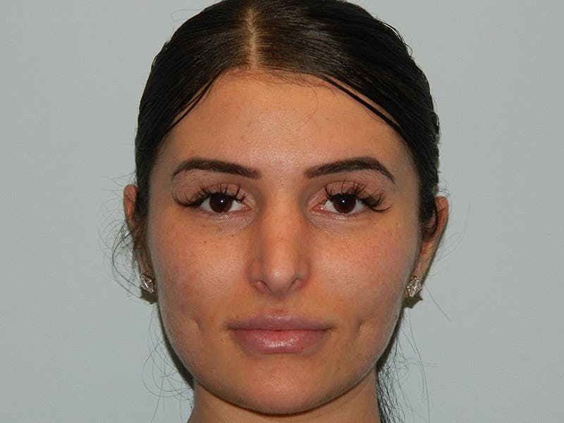 Rhinoplasty Before & After Gallery - Patient 133066313 - Image 5