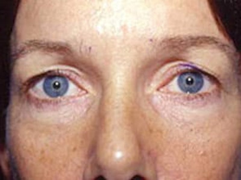 Brow Lift Before & After Gallery - Patient 133066308 - Image 1