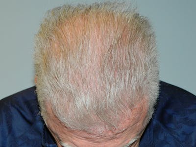 Hair Transplant (Smartgraft) Before & After Gallery - Patient 133066312 - Image 2