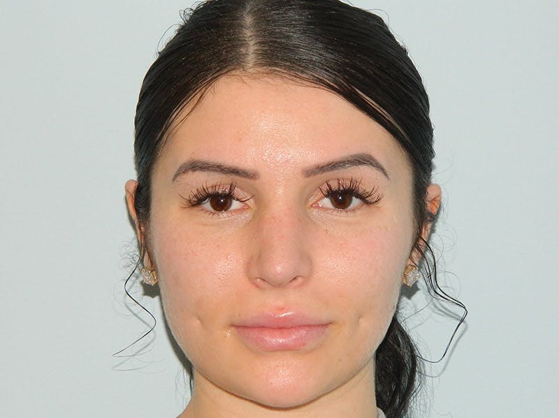 Rhinoplasty Before & After Gallery - Patient 133066313 - Image 6