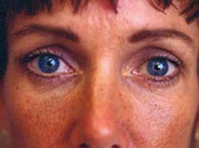 Brow Lift Before & After Gallery - Patient 133066308 - Image 2