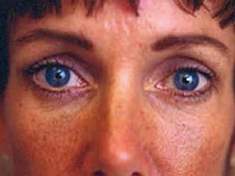 Brow Lift Before & After Gallery - Patient 133066308 - Image 2