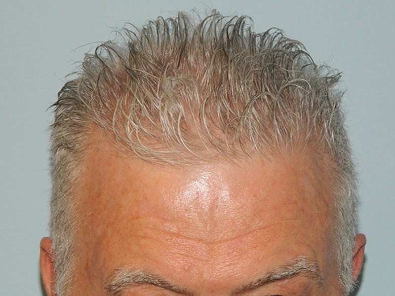 Hair Transplant (Smartgraft) Before & After Gallery - Patient 133066312 - Image 3